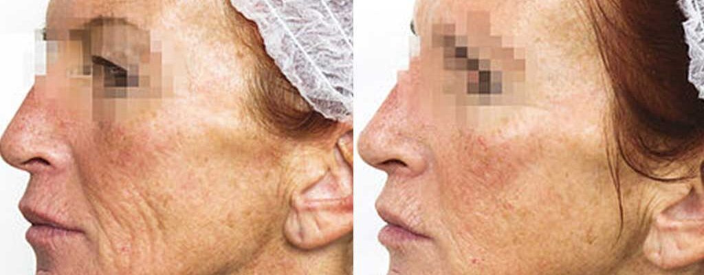 prx-t33-before-after3