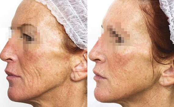 prx-t33-before-after3