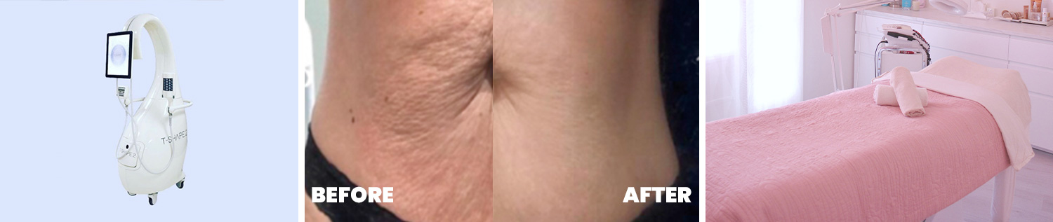 T-Shape-2-Body-Treatment