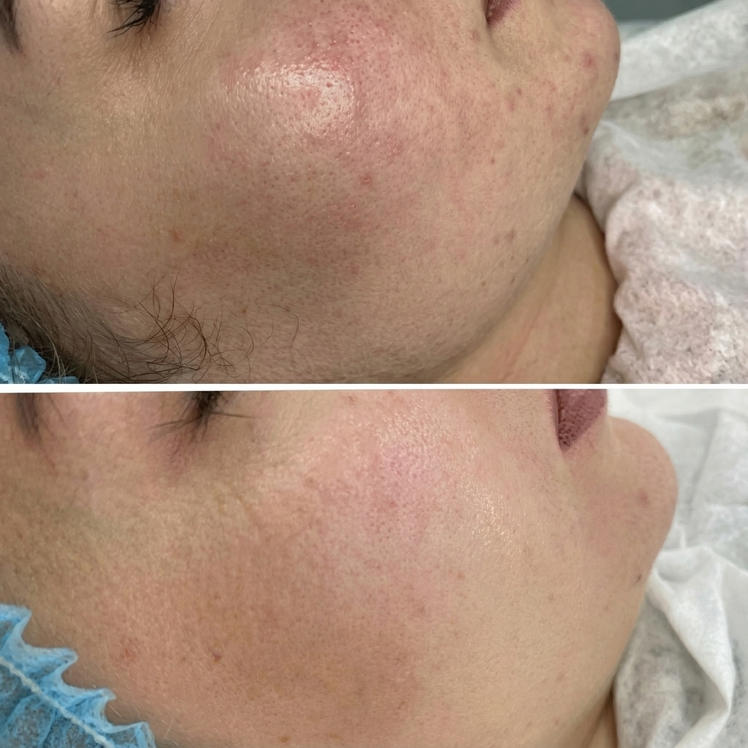 BioRePeel & Microneedling- The Smart Approach to Post-Summer Pigmentation
