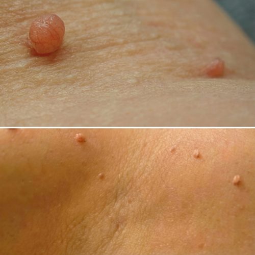 Steelwratjes verwijderen_1