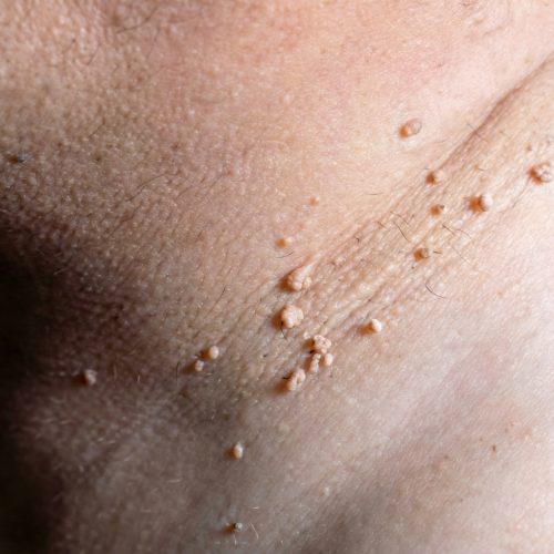 Steelwratjes verwijderen_2