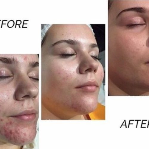 Teen Gezichtsbehandeling_1