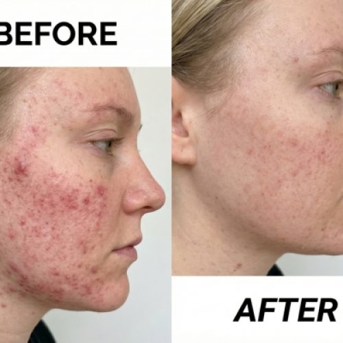 Teen Gezichtsbehandeling_2